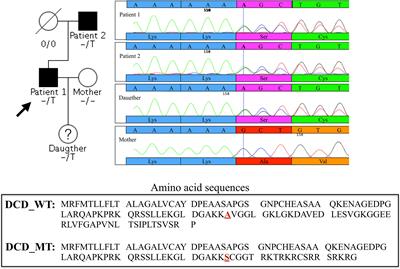 A rare loss-of-function genetic mutation suggest a role of dermcidin deficiency in hidradenitis suppurativa pathogenesis